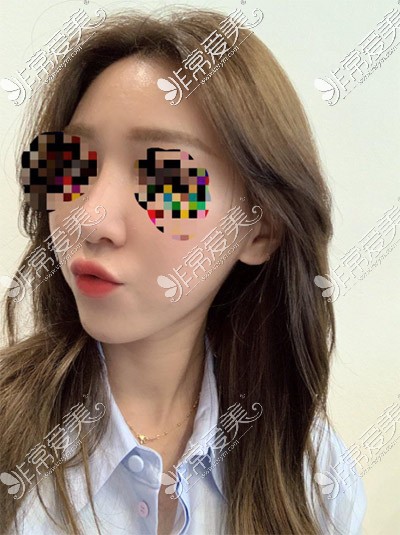 韩国玉芭uber整形医院做鼻子图片