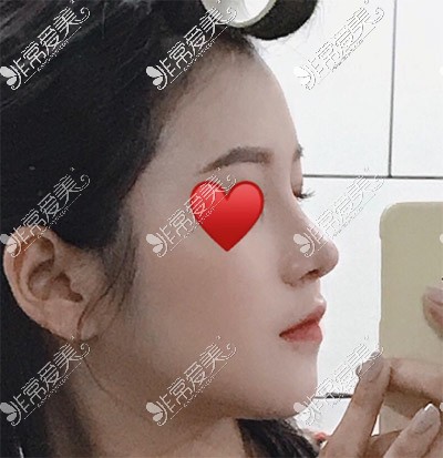 韩国玉芭uber隆鼻手术照片