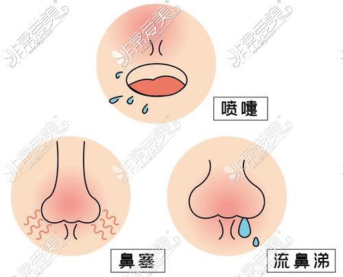 隆鼻影響鼻塞