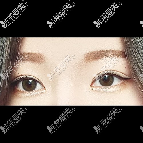 韩国icon整形医院双眼皮手术效果