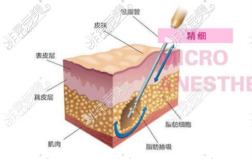 哈尔滨腰腹吸脂哪家医院好？盘点冰城瘦身效果好的医院！