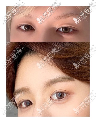 韩国icon整形医院男士双眼皮对比图
