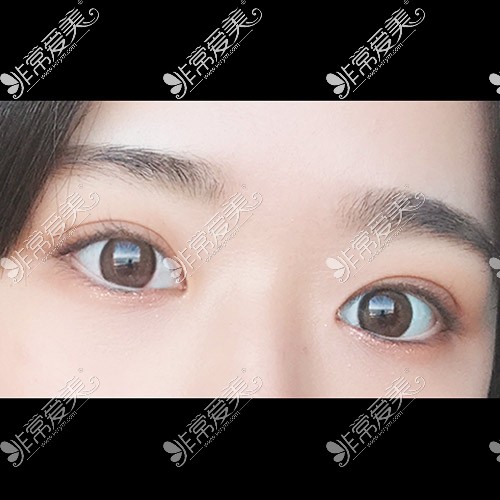 韩国icon整形医院双眼皮恢复照