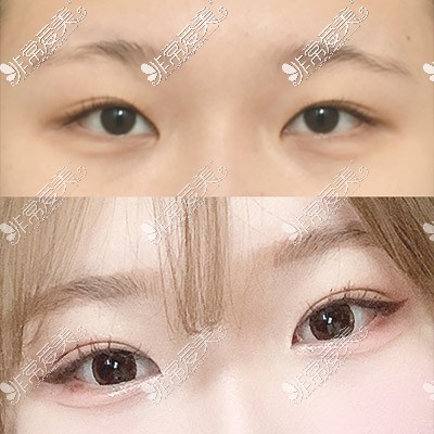 韩国icon整形医院双眼皮对比图