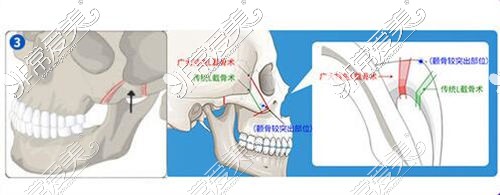 广州颧骨手术哪家整形医院做的好?推荐广州颧骨内推医院