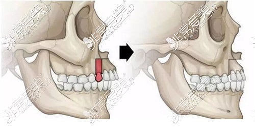 正頜手術(shù)示意圖