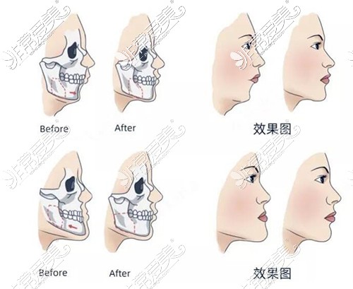 石家庄颌面外科好的医院盘点，还附带正颌手术费用！