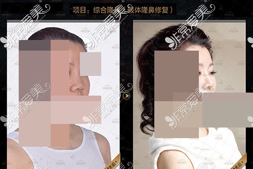 潍坊鼻修复哪家医院好?盘点潍坊修复鼻子效果好的医院医生