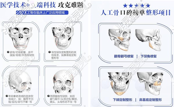 下颌角削多了有补救的办法吗？下颌角切多了补骨行不行