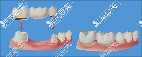 大连固定假牙示意图