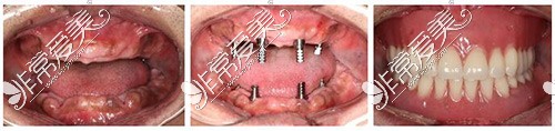 全口种植牙示意图