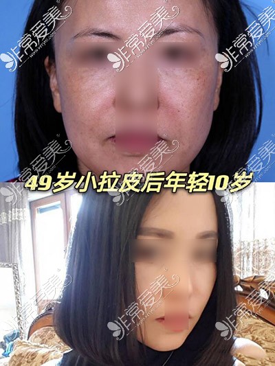 北京加减美整形穆宝安医师拉皮手术