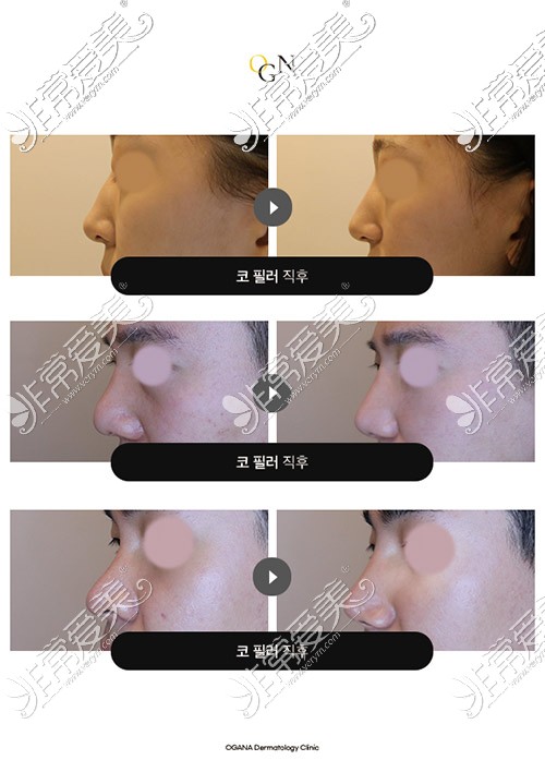 韩国吴佳娜皮肤科玻尿酸隆鼻照片