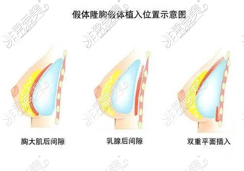 公开广州假体隆胸价格表!哪家整形医院做隆胸口碑比较好呢