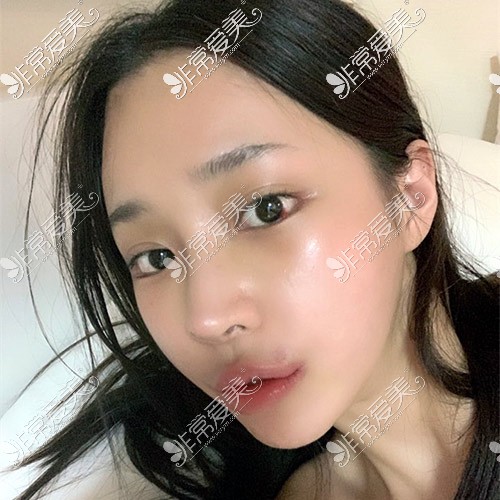 韩国现代美学做鼻子术后十四天照片