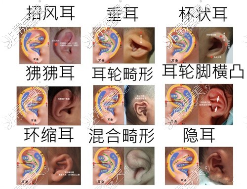 武汉耳朵畸形矫正医院名单,专门治疗贴发耳小耳症花生耳!