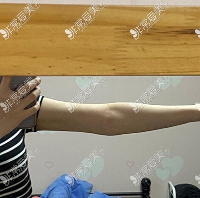 韩国梦线整形吸脂瘦手臂1个月照片