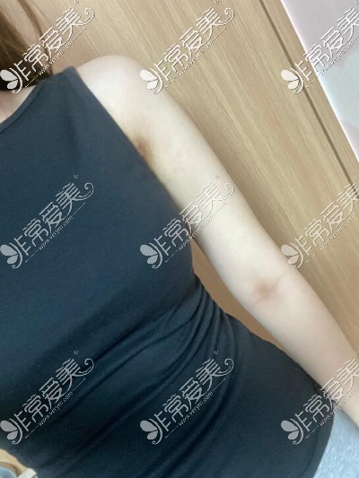 韩国梦线整形吸脂瘦手臂1个月