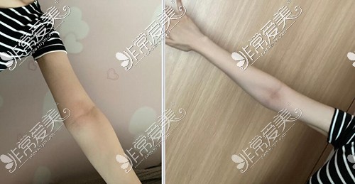韩国梦线整形手臂吸脂三个月效果