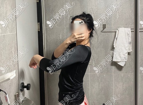 韩国梦线手臂吸脂+肩胛骨吸脂术后一个月侧面照