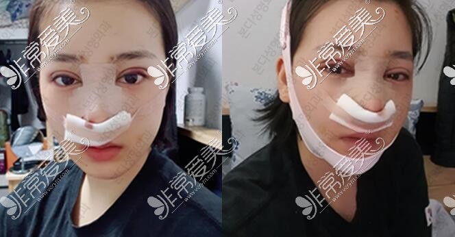 韩国BornDi整形医院做鼻子照片