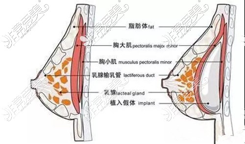 隆胸示意图