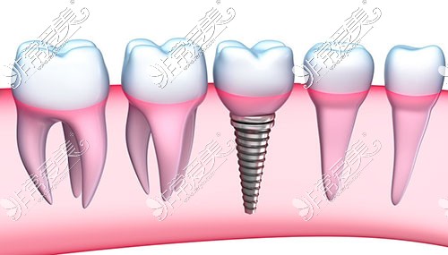 种植牙示意图