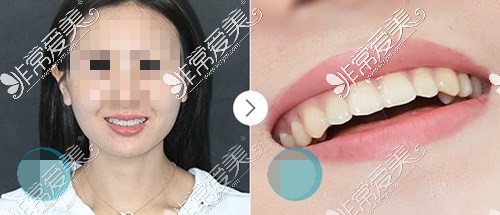 深圳格伦菲尔牙科口腔医院牙齿矫正对比照片