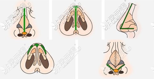 陳運生醫(yī)生隆鼻搭建技術