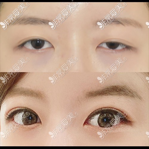韩国icon眼睛睁眼无力矫正照片