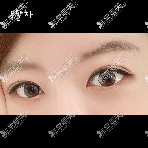 韩国icon双眼皮手术照片