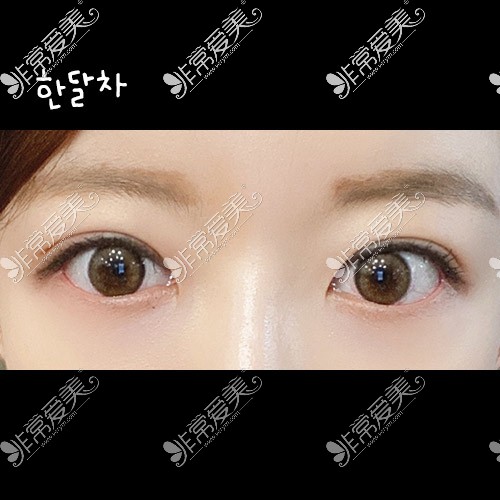 韩国icon整形医院双眼皮矫正照片