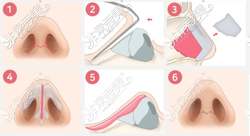 鼻支架搭建流程