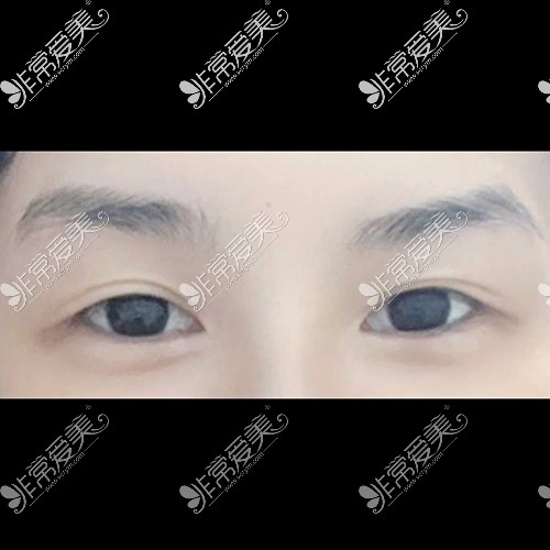 韩国icon整形医院双眼皮照片