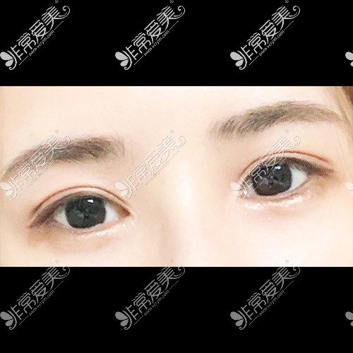 韩国icon双眼皮手术恢复图