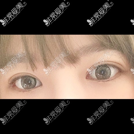韩国icon整形医院双眼皮术后照