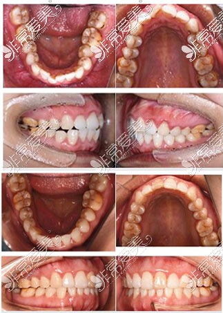 深圳世纪河山口腔医院牙齿矫正对比照片