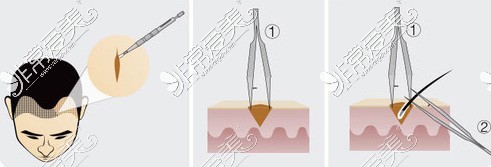 大麦微针植发方式