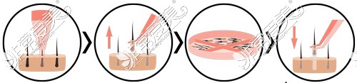 微针植发流程