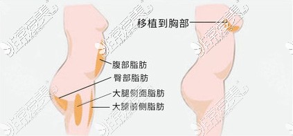 杭州同荣丽格医疗美容自体脂肪隆胸