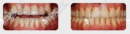 南京博韵口腔医院牙齿矫正对比照片