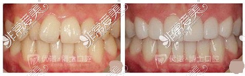 青岛牙博士口腔牙齿矫正对比照片