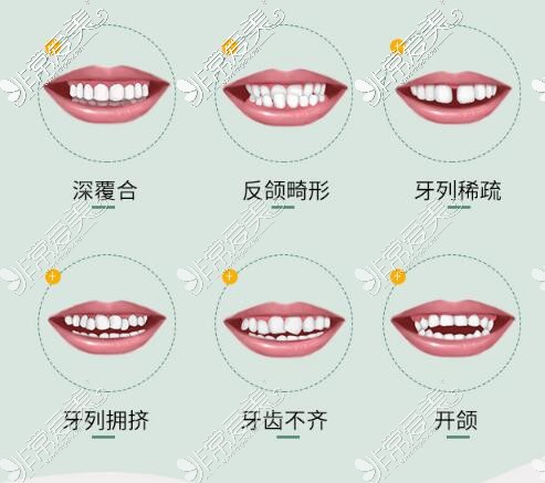 哪些牙齿需要进行正畸改善