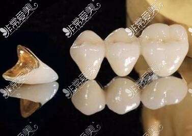 牙冠修复材料对比图