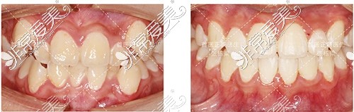 北京禾禾齿科张栋梁牙齿正畸对比照片