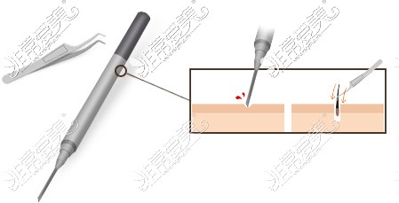 植发使用微针笔