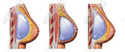 煙臺華怡整形醫(yī)院三種植入方式