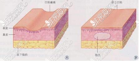 厦门薇格自体脂肪填充