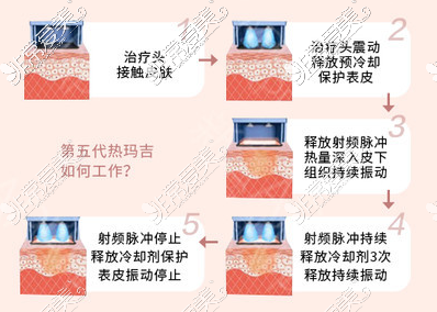 廈門思明薇格第五代熱瑪吉工作原理