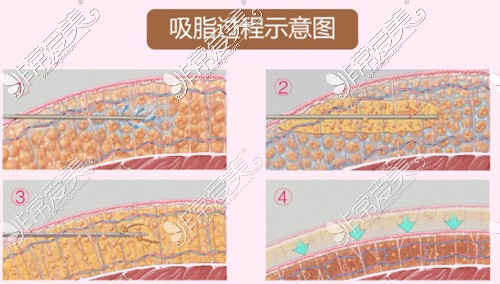 南京华美医疗美容医院吸脂过程